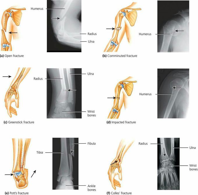 Common types of bone fractures