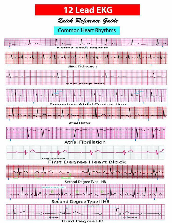 Arrhythmias
