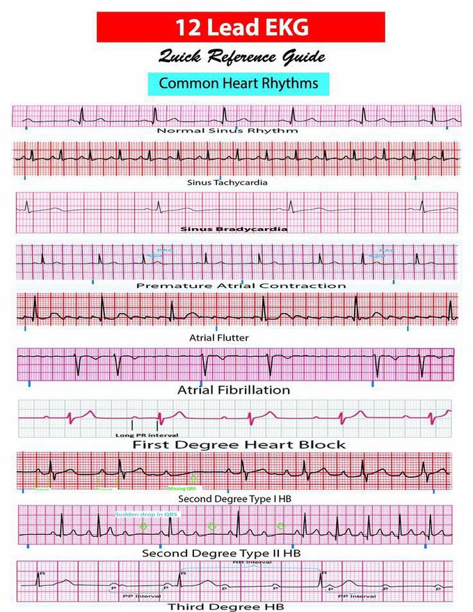 Arrhythmias - MEDizzy