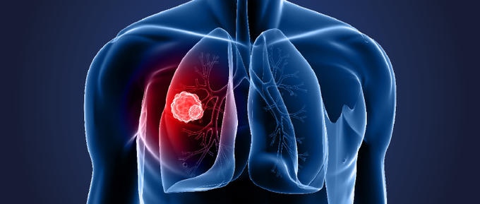 Risk Factors of Lung Cancer