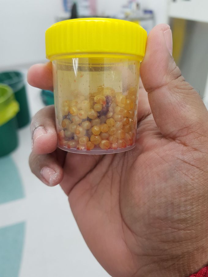 Gall bladder stones