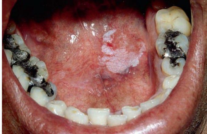 Idiopathic leukoplakia