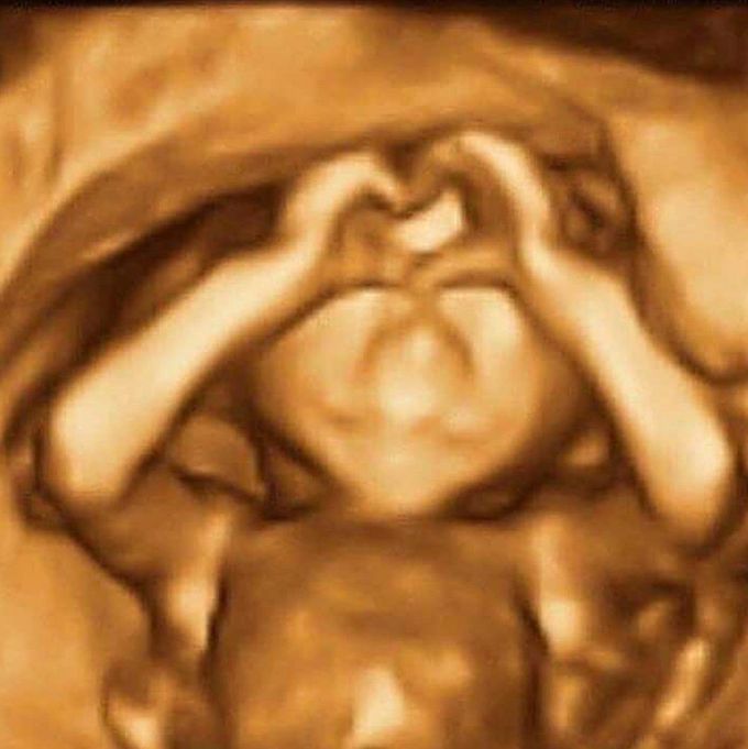 3D Ultrasound of Fetus