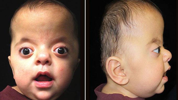 Cause of Apert syndrome