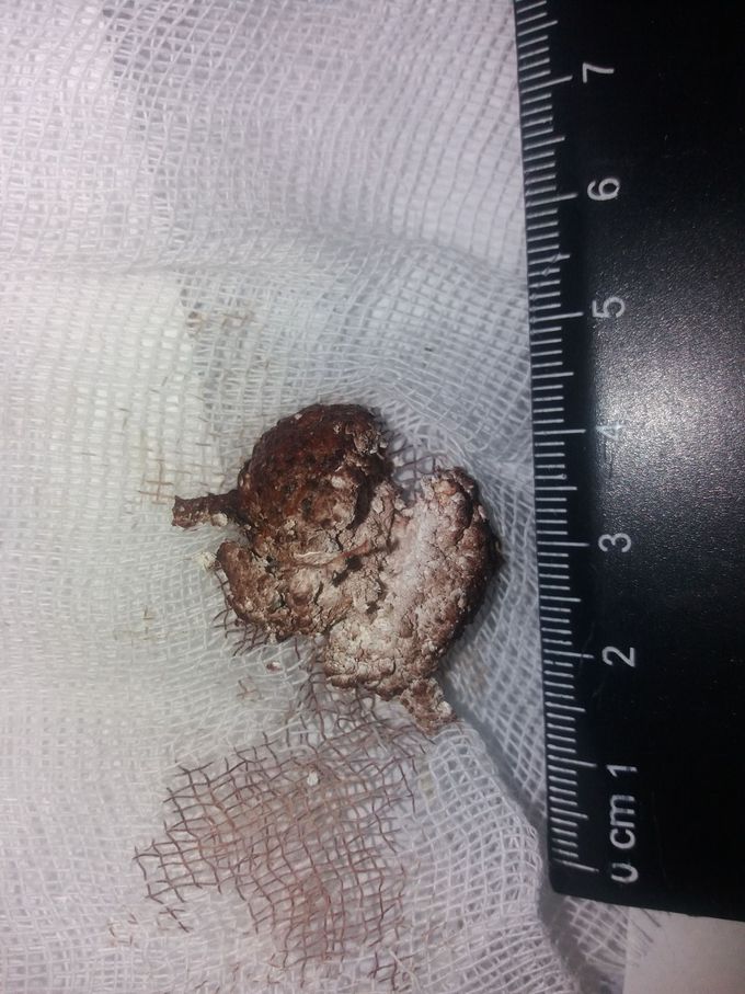 Stouns of tissue After injection. After 1 year