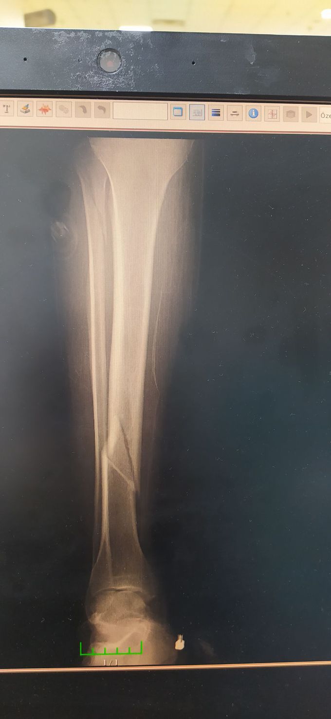 Post-football fracture