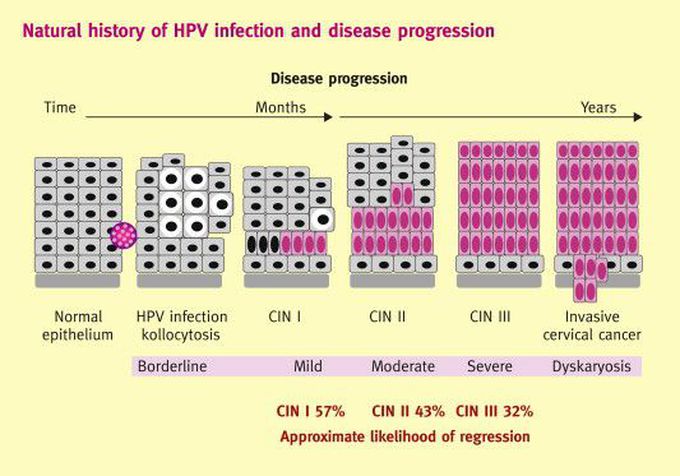 Progression of Cervical Intra-epithelial Neoplasia (CIN) into Cervical Cancer