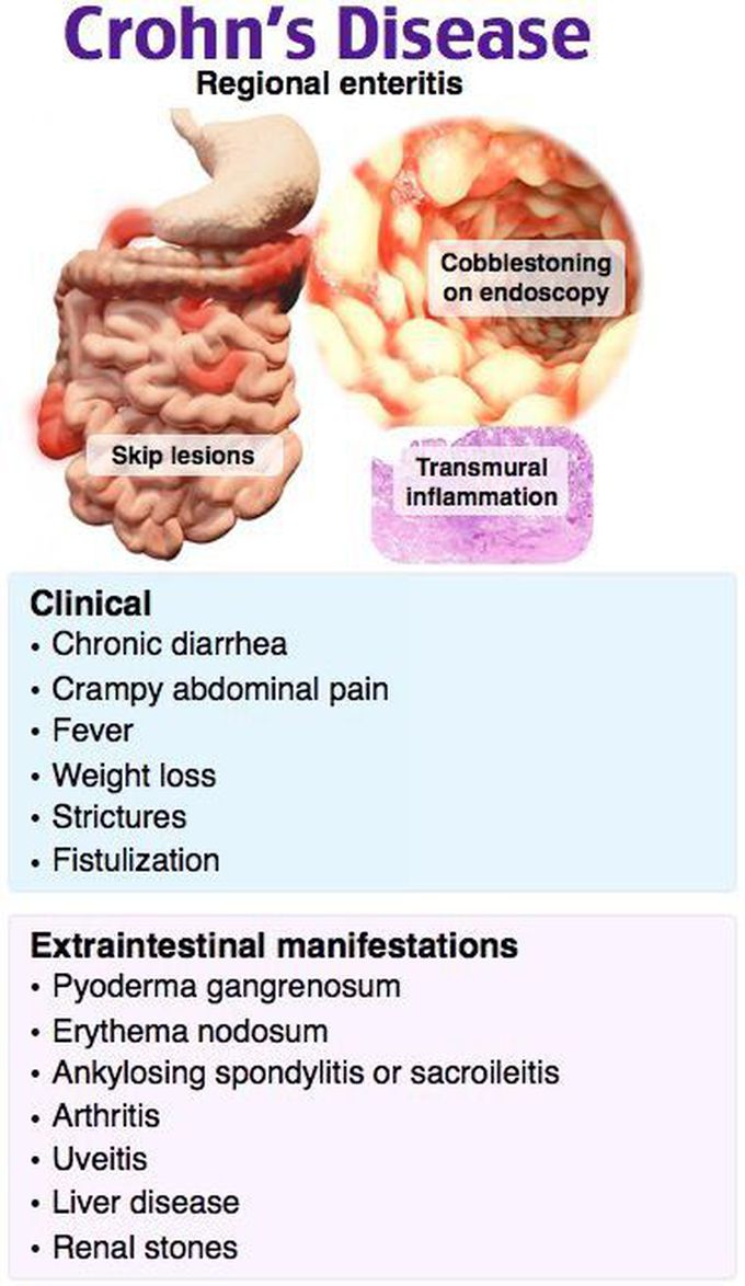 Crohn's disease