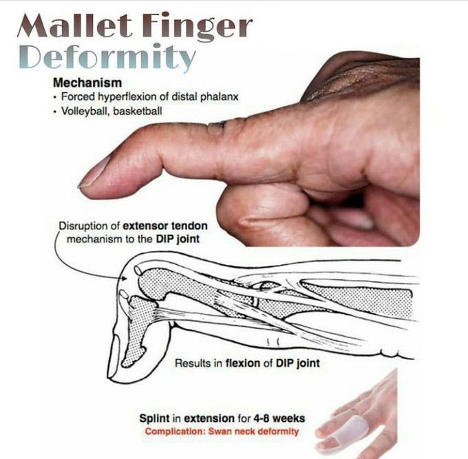 Mallet finger deformity
