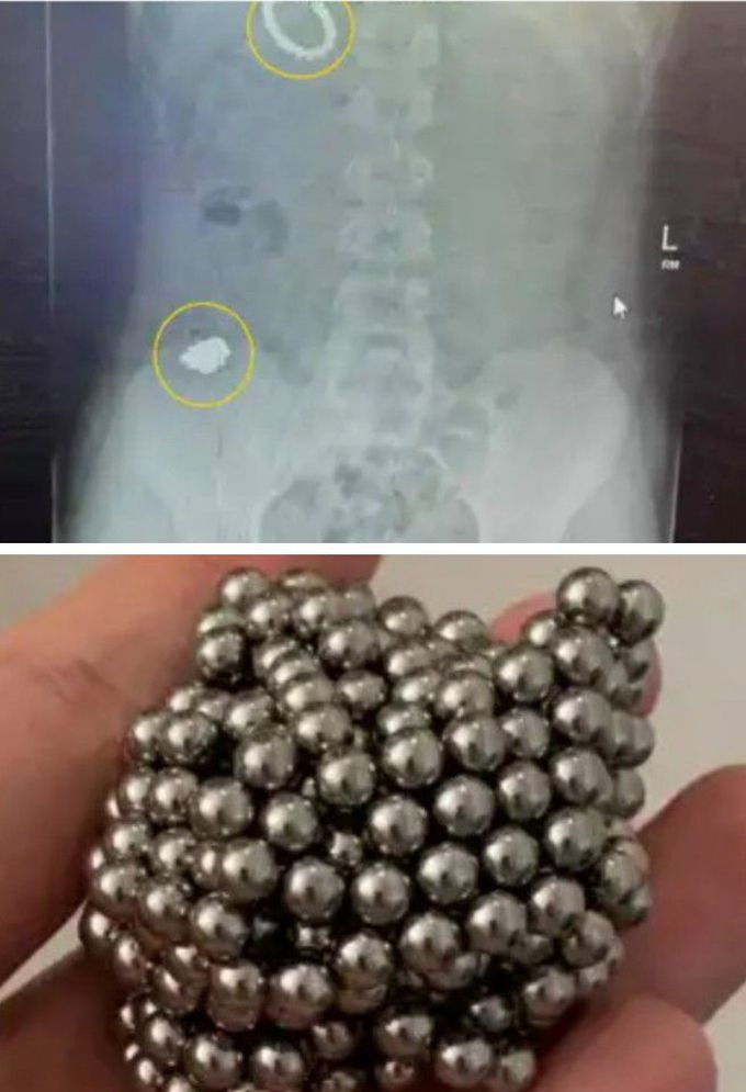 A 12 years old boy swallowed 54 magnets to see if he could become magnetic!