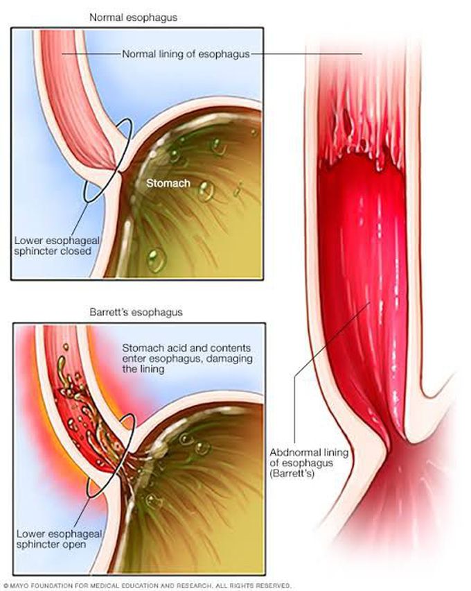 Barrets Esophagus