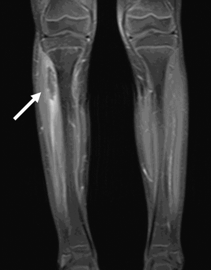 Osteomyelitis in Children: From Presentation, Diagnosis, and Pathogens to Management