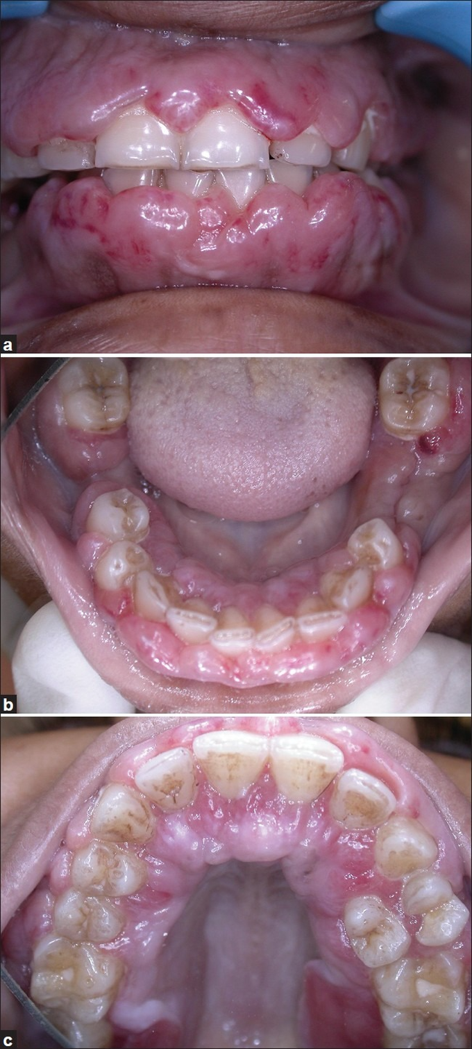Myelomonocytic leukemia presenting with gingival hypertrophy