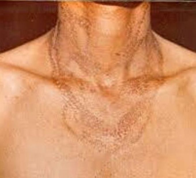 Casal's necklace pattern