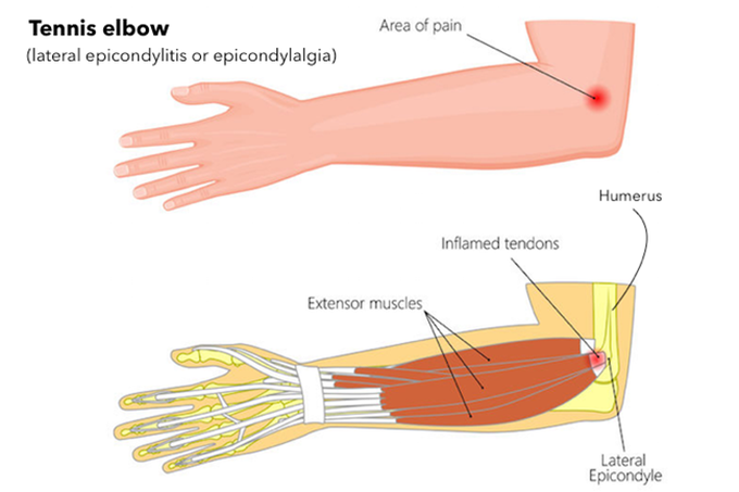 TENNIS ELBOW