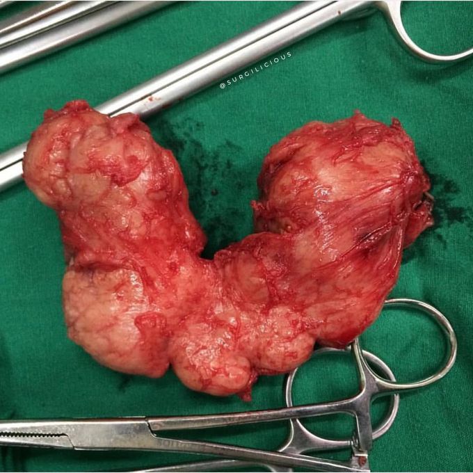 Prostate enlargement taken from open prostatectomy