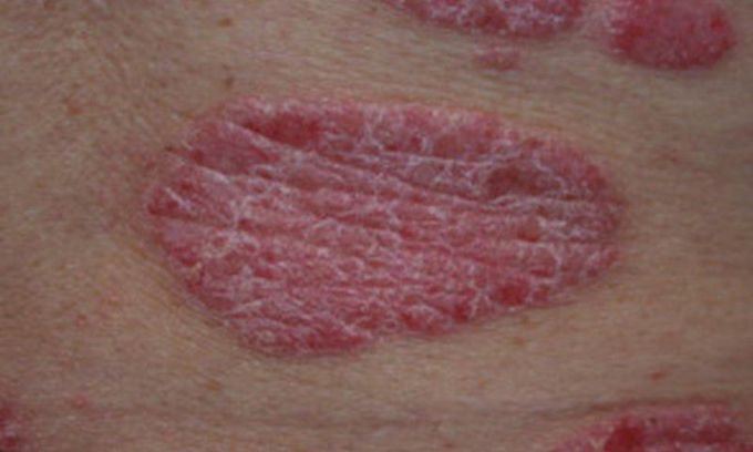 Psoriasis