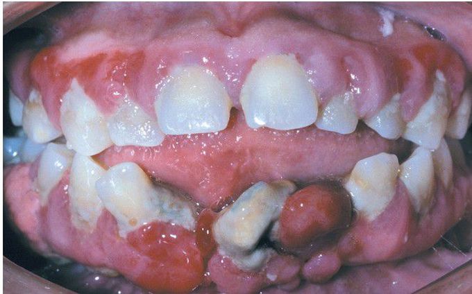 Phenytoin-Related Gingival Hyperplasia