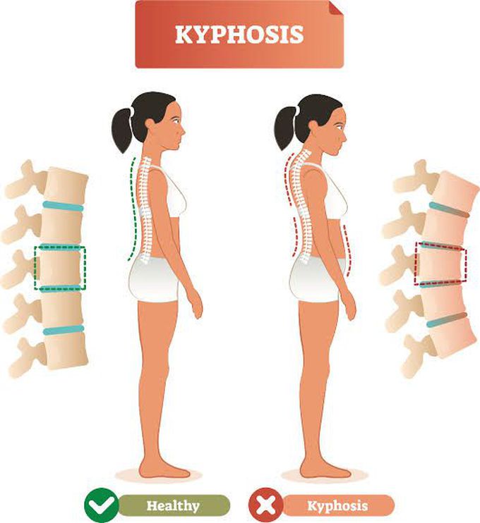 Kyphosis treatment
