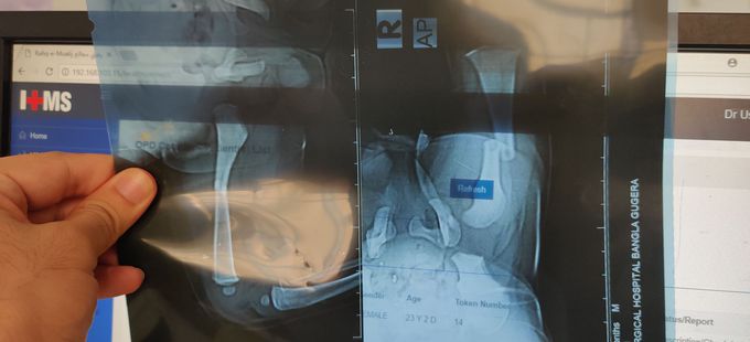 R Femur Fracture in Child