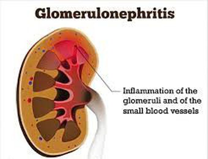 Glomerulonephritis