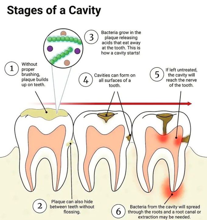 Stages of cavity