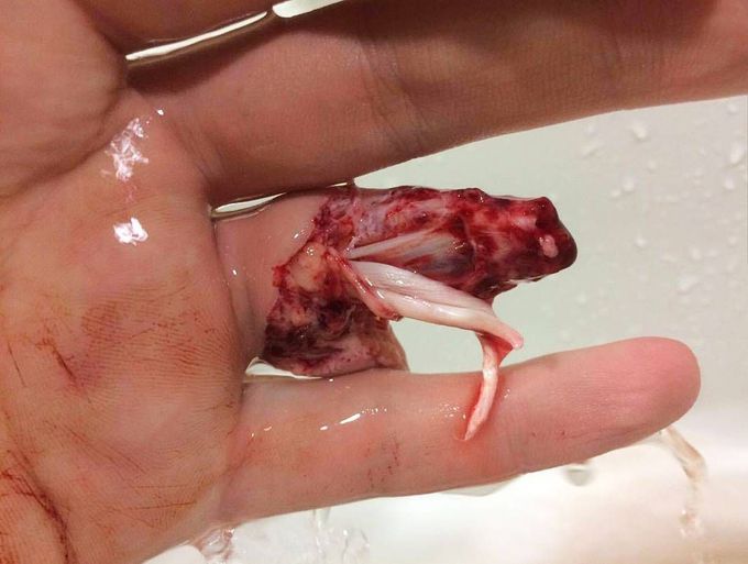 A man had half of his finger ripped off by his wedding ring during a football match