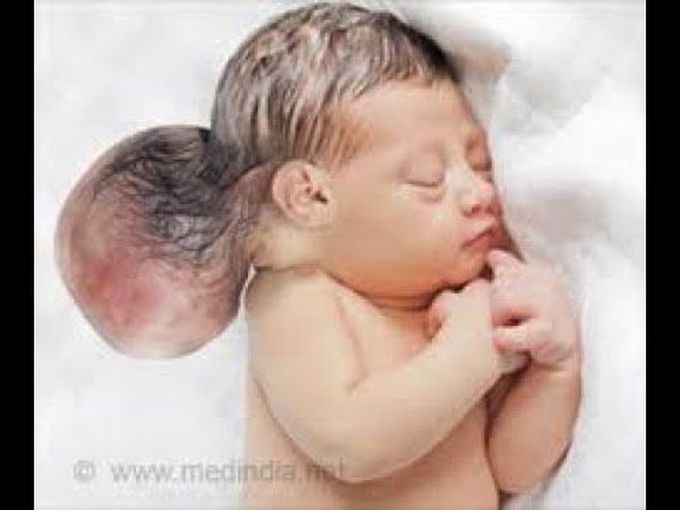 Encephaloceles-Neural Tube Defect