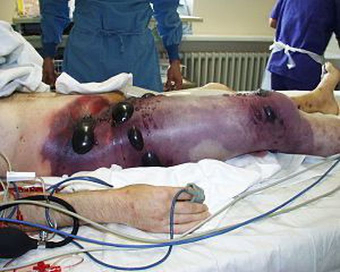 Gas Gangrene