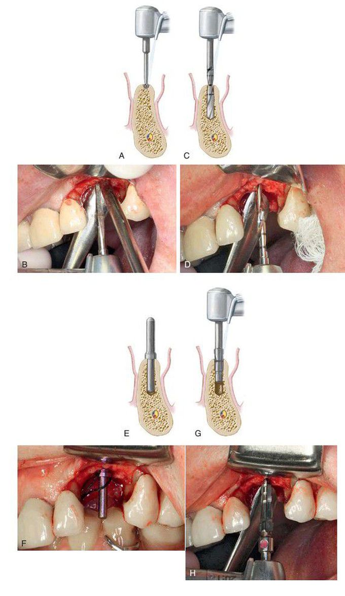 Implant placement