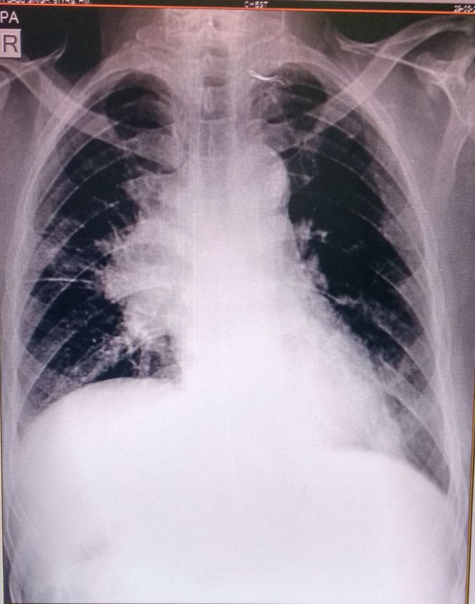 Superior Vena Cana Syndrome