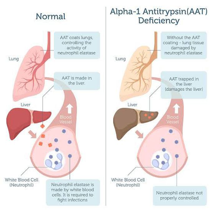 Alpha 1 antitrypsin Deficiency