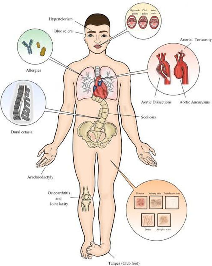 These are the clinical features of Loeyz syndrome