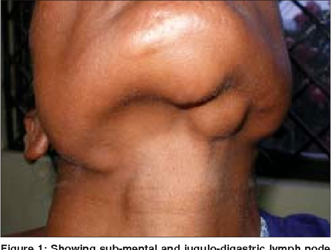 Infectious Causes of Cervical Lymphadenopathy