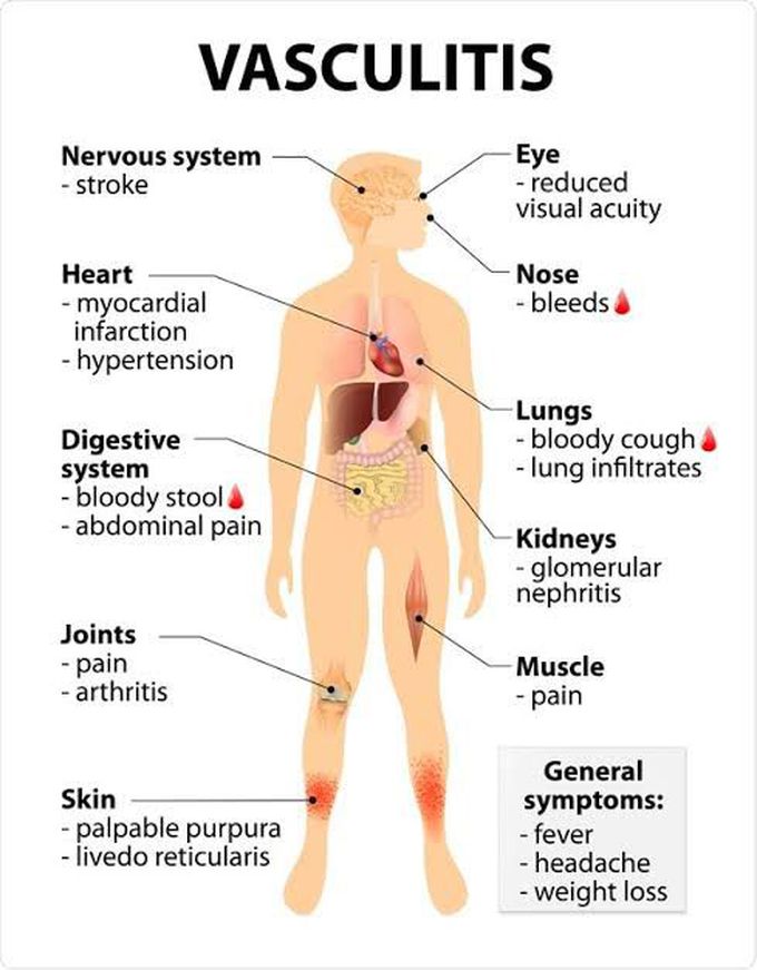 Symptoms of vasculitis