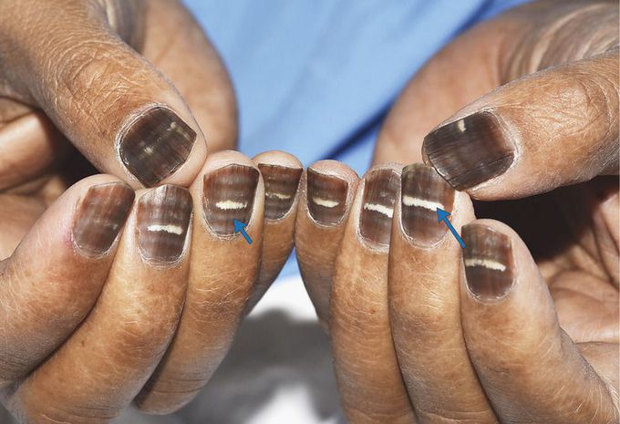 Nail Changes during Chemotherapy