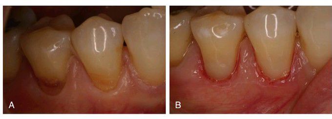 Restoration of root surface lesions