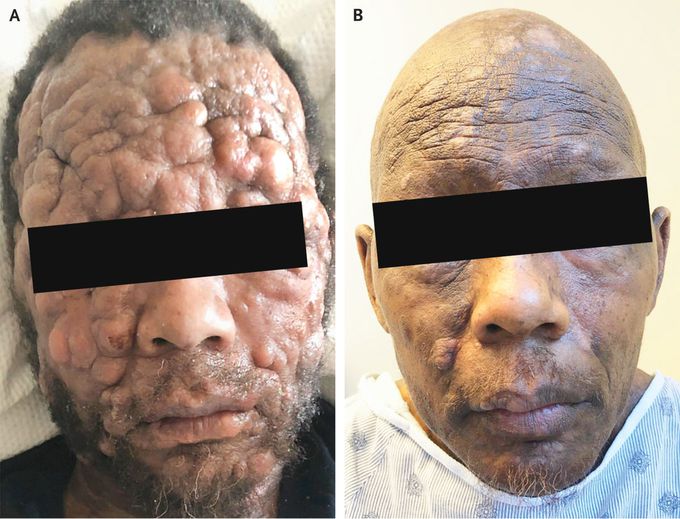 Advanced Mycosis Fungoides