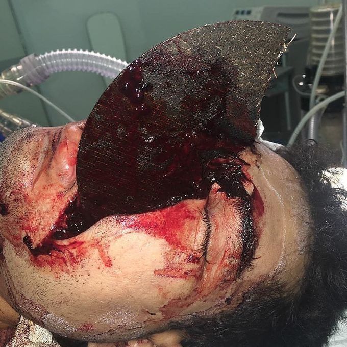 Angle grinder injury causing severe facial trauma! 