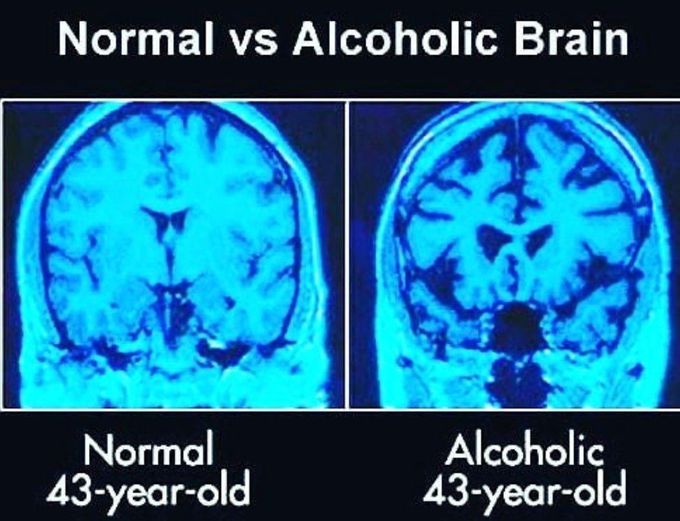 Normal Vs Alcoholic Brain Stop The Use Of Alcohol Medizzy 7442