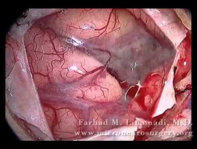 Brain surgery removal of metastatic tumor high power surgical microscope