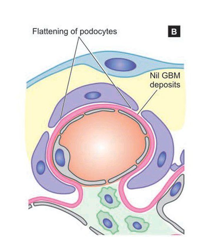 Minimal change disease