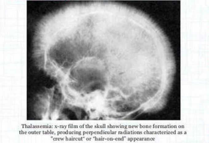 Crew cut (named after the hair cut) appearance of skull seen in thalassemia.