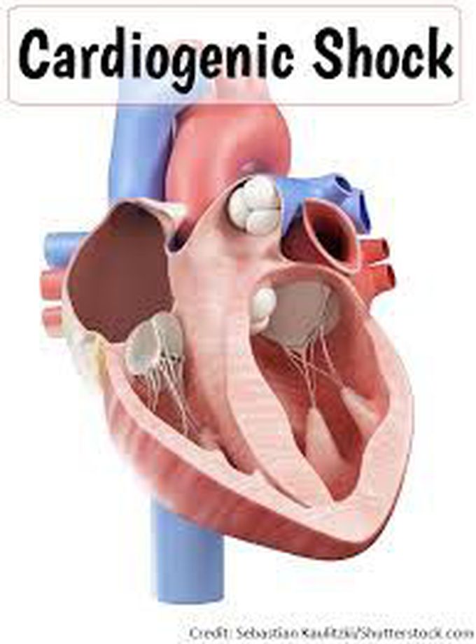 What is cardiogenic shock