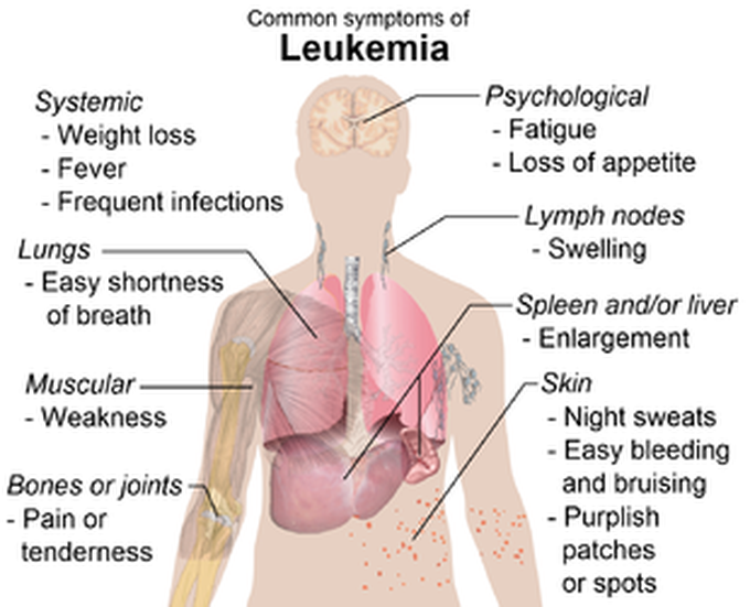 Common symptoms of leukemia