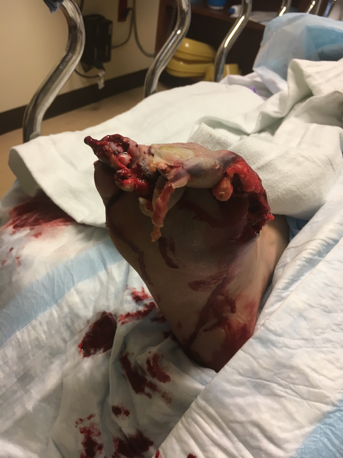 Evaluation And Management Of Crush Injuries Of The Foot
