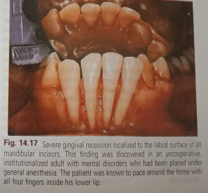 Severe Gingival Recession