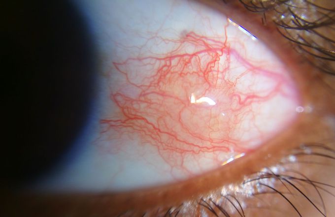 EPISCLERITIS