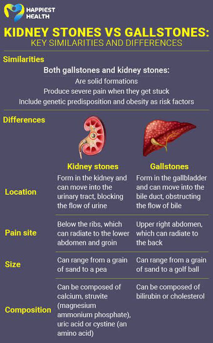 Kidney Stones Vs Gallstones