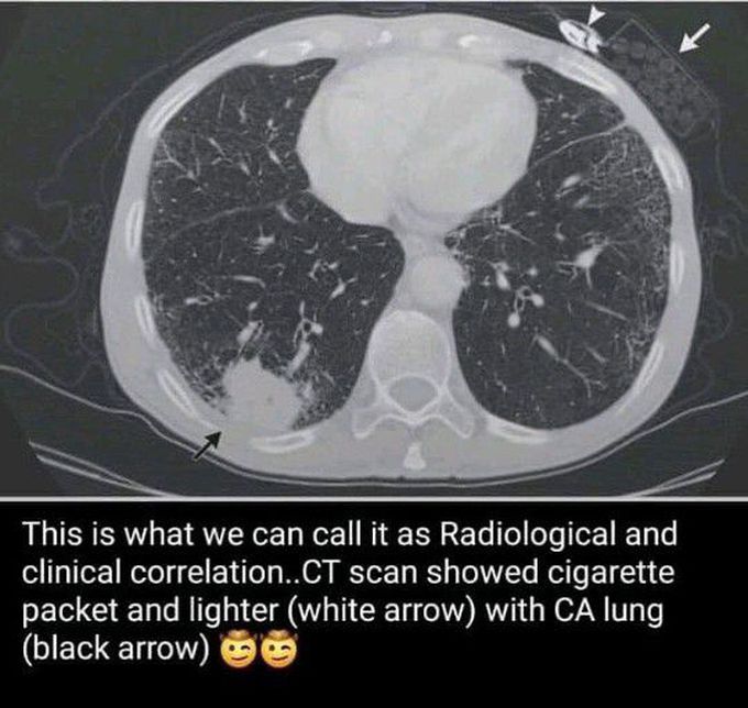 CT scan